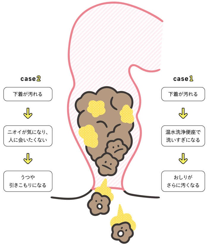 おなかがゆるい、下痢をくり返す。実はこれも「便秘」!? 汗や口のニオイにも関係する「出口の便秘」（6）