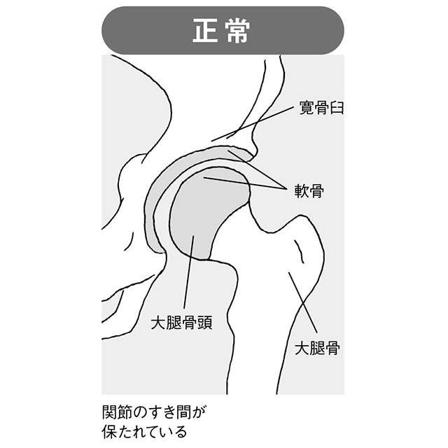 痛みで歩行が困難に...。注意すべき「変形性股関節症」について医師の大嶋浩文先生が解説（3）