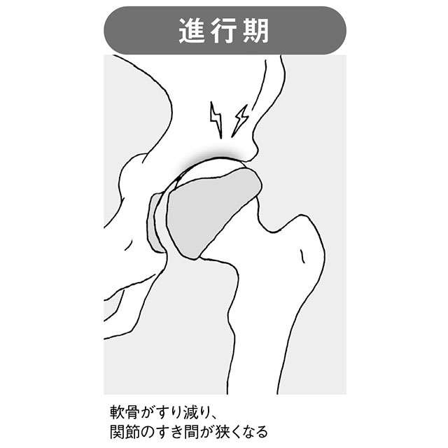 痛みで歩行が困難に...。注意すべき「変形性股関節症」について医師の大嶋浩文先生が解説（4）