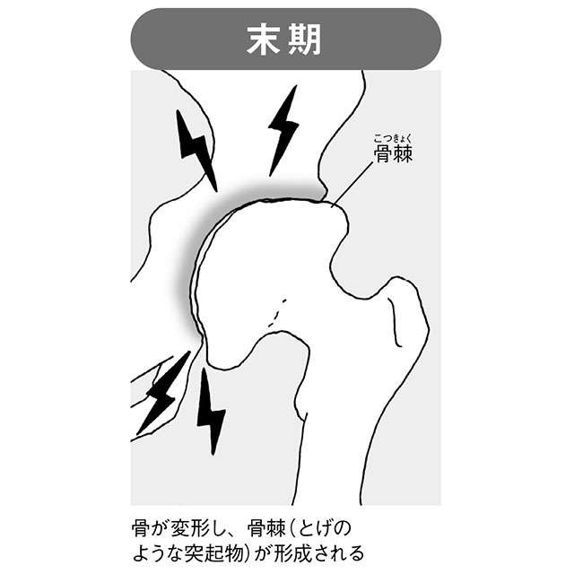 痛みで歩行が困難に...。注意すべき「変形性股関節症」について医師の大嶋浩文先生が解説（5）