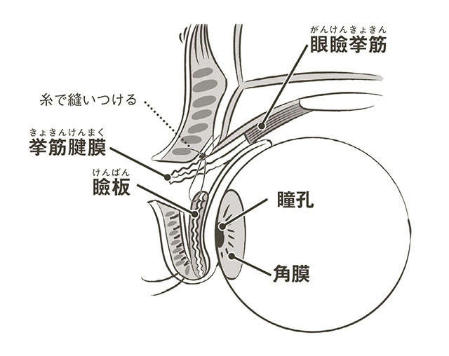 目が開けにくい、視野が狭い...上まぶたが下がる「眼瞼下垂」を医師の村上正洋先生が解説（7）