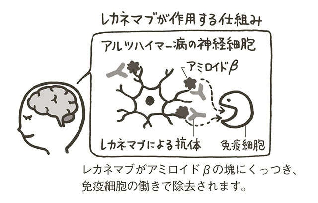 アルツハイマー病の新治療薬「レカネマブ」。治療法や自己負担額など認知症専門の羽生春夫先生が解説（2）