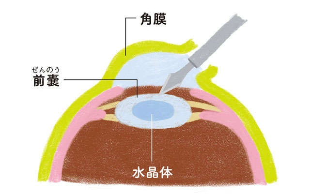 70歳で90％、80歳以上はほぼ全員が白内障に。「QOLがアップする白内障レンズ選び」【眼科専門医・平松類先生】（16）