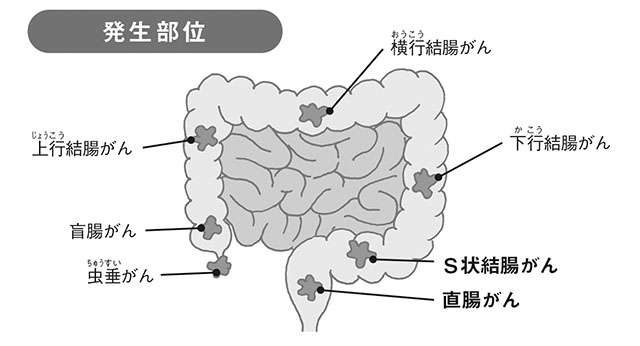 女性のがん死亡数1位の「大腸がん」。専門医の斎藤豊先生が早期発見・早期治療が重要な理由を解説（5）