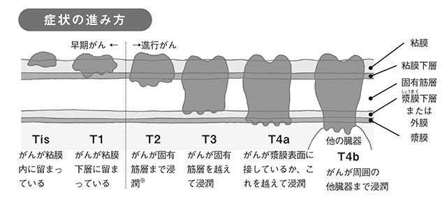女性のがん死亡数1位の「大腸がん」。専門医の斎藤豊先生が早期発見・早期治療が重要な理由を解説（7）