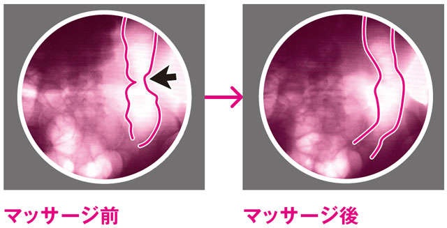 「腸ゆらしマッサージ」で便秘解消！手順とポイントを便秘外来医が解説（3）