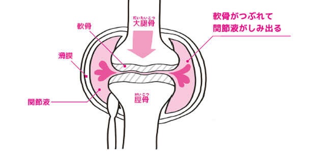 【ひざの寿命を延ばす！】ひざの痛みと変形を防ぐために「軟骨を守る」方法（3）