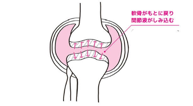 【ひざの寿命を延ばす！】ひざの痛みと変形を防ぐために「軟骨を守る」方法（4）