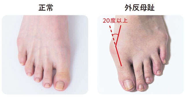 【坐骨神経痛対策】自分の足の状態が分かる4つのポイント。小さな段差につまずく方は要注意！（4）