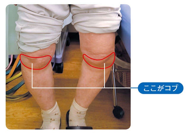 ひざ痛に悩む方は必見！ 「ひざのコブ」についてセルフチェック／ひざ痛ほぐし1分ストレッチ（10）