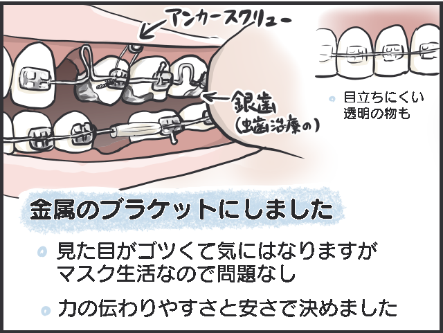 40代主婦「歯科矯正」はじめました。費用は？ 痛みは？ 食事はどうする？ 体験レポ／フニャコ（3）