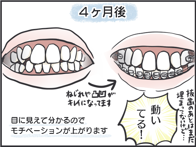 40代主婦「歯科矯正」はじめました。費用は？ 痛みは？ 食事はどうする？ 体験レポ／フニャコ（7）