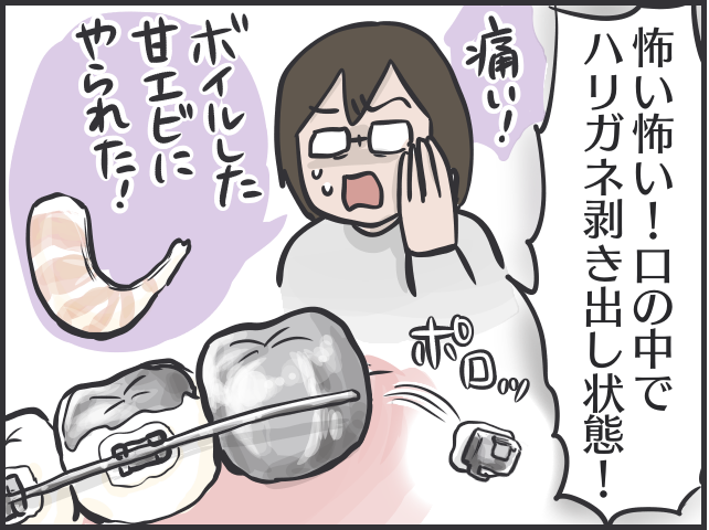 目に見えて綺麗に並んでいく歯に感動！ 2年半でここまで変わった、大人の「歯科矯正」体験記／フニャコ（2）