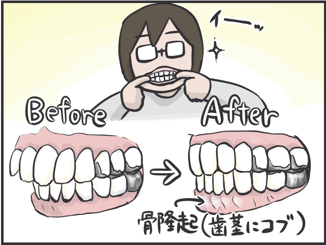 目に見えて綺麗に並んでいく歯に感動！ 2年半でここまで変わった、大人の「歯科矯正」体験記／フニャコ（8）
